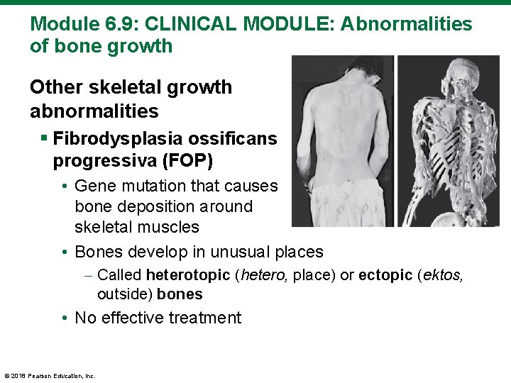 Module 6. 9: CLINICAL MODULE: Abnormalities of bone growth Other skeletal growth abnormalities §