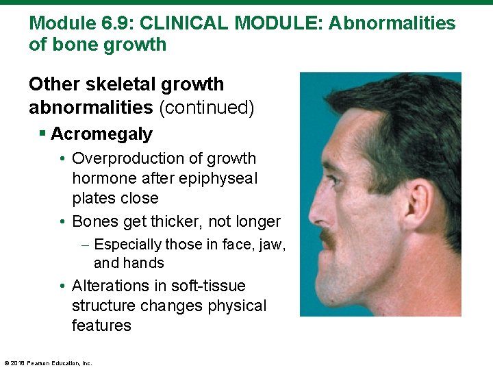 Module 6. 9: CLINICAL MODULE: Abnormalities of bone growth Other skeletal growth abnormalities (continued)