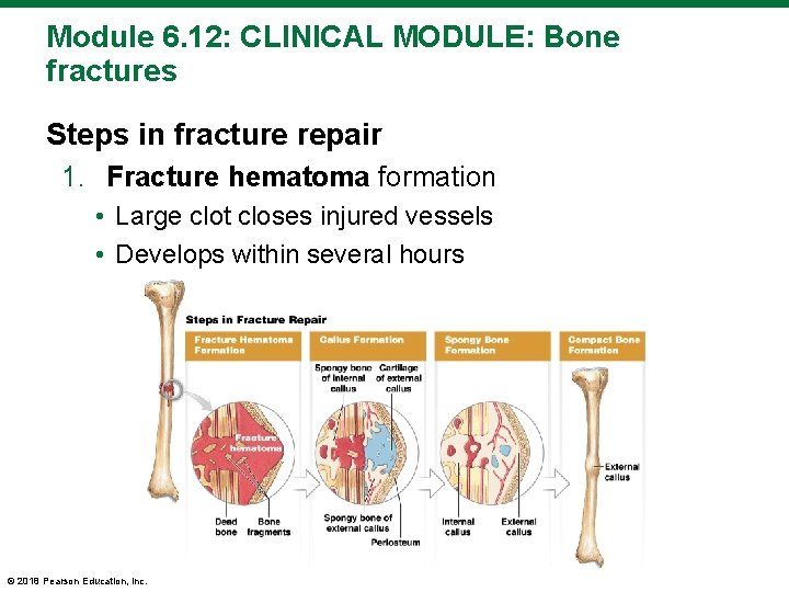 Module 6. 12: CLINICAL MODULE: Bone fractures Steps in fracture repair 1. Fracture hematoma