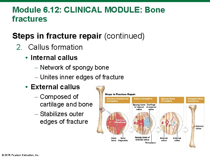 Module 6. 12: CLINICAL MODULE: Bone fractures Steps in fracture repair (continued) 2. Callus