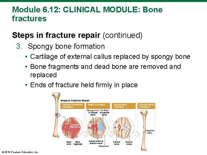 Module 6. 12: CLINICAL MODULE: Bone fractures Steps in fracture repair (continued) 3. Spongy