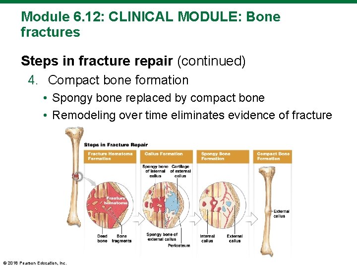 Module 6. 12: CLINICAL MODULE: Bone fractures Steps in fracture repair (continued) 4. Compact