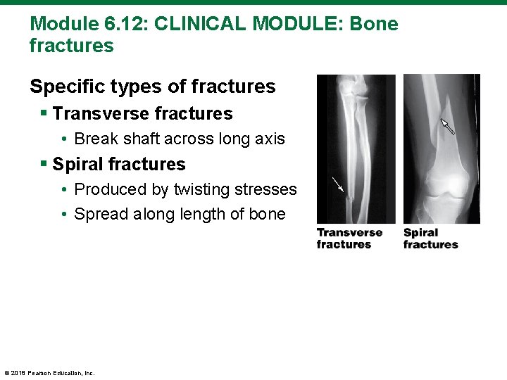 Module 6. 12: CLINICAL MODULE: Bone fractures Specific types of fractures § Transverse fractures