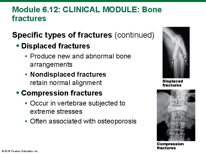 Module 6. 12: CLINICAL MODULE: Bone fractures Specific types of fractures (continued) § Displaced
