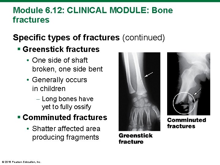 Module 6. 12: CLINICAL MODULE: Bone fractures Specific types of fractures (continued) § Greenstick