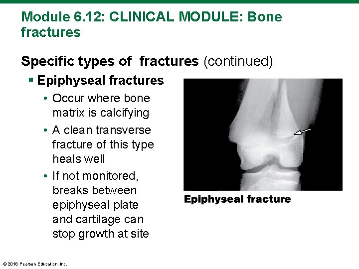 Module 6. 12: CLINICAL MODULE: Bone fractures Specific types of fractures (continued) § Epiphyseal