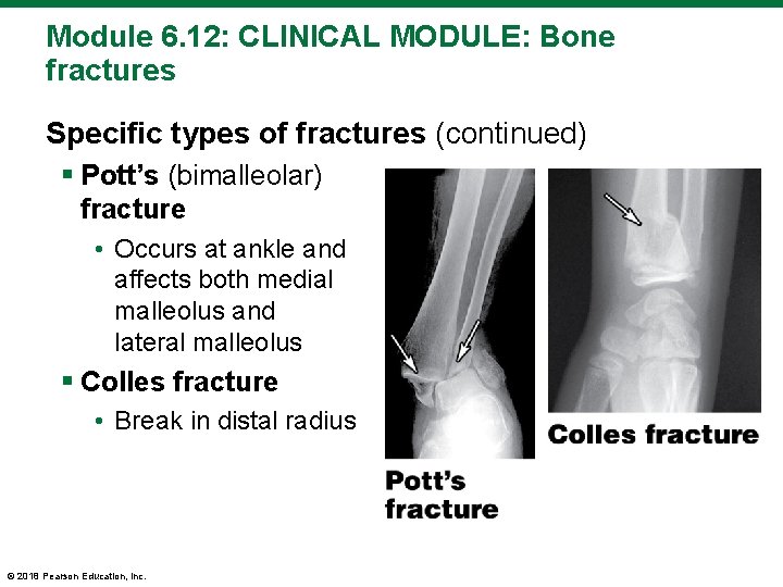 Module 6. 12: CLINICAL MODULE: Bone fractures Specific types of fractures (continued) § Pott’s
