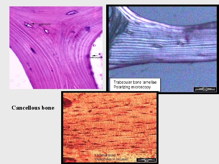 Cancellous bone 