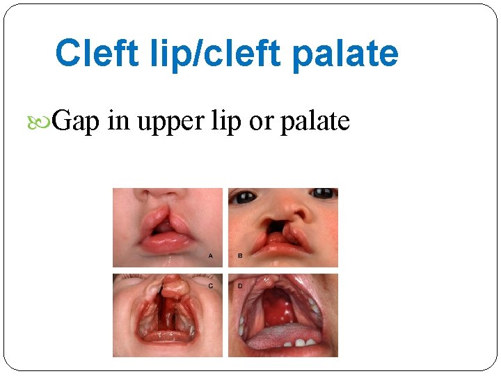 Cleft lip/cleft palate Gap in upper lip or palate 