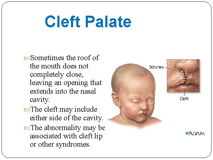 Cleft Palate Sometimes the roof of the mouth does not completely close, leaving an