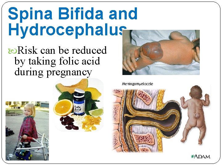 Spina Bifida and Hydrocephalus Risk can be reduced by taking folic acid during pregnancy