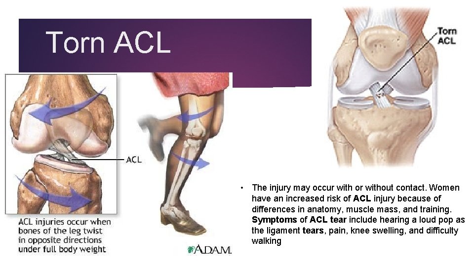 Torn ACL • The injury may occur with or without contact. Women have an