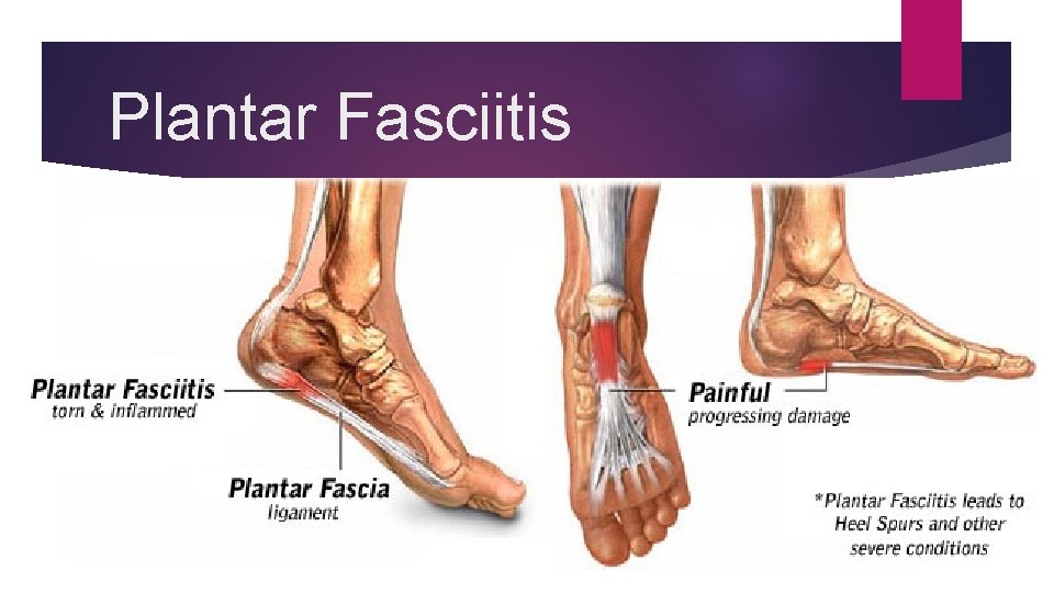 Plantar Fasciitis 