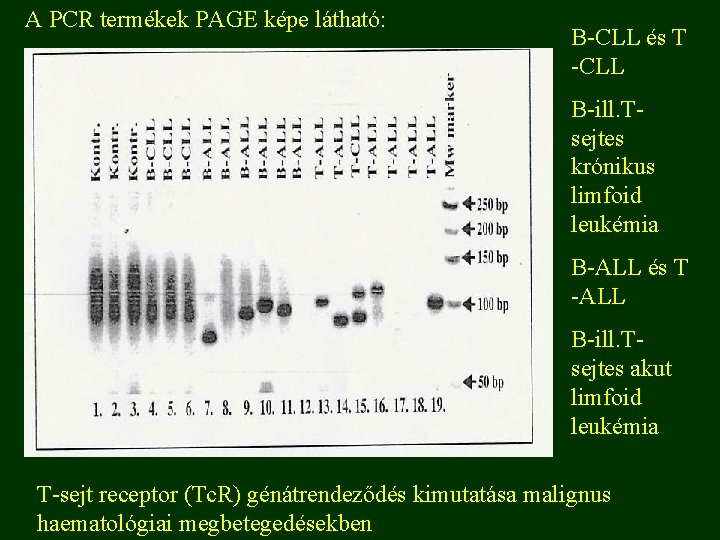 A PCR termékek PAGE képe látható: B-CLL és T -CLL B-ill. Tsejtes krónikus limfoid