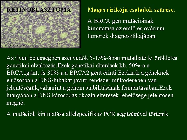 RETINOBLASZTOMA Magas rizikójú családok szűrése. A BRCA gén mutációinak kimutatása az emlő és ovárium