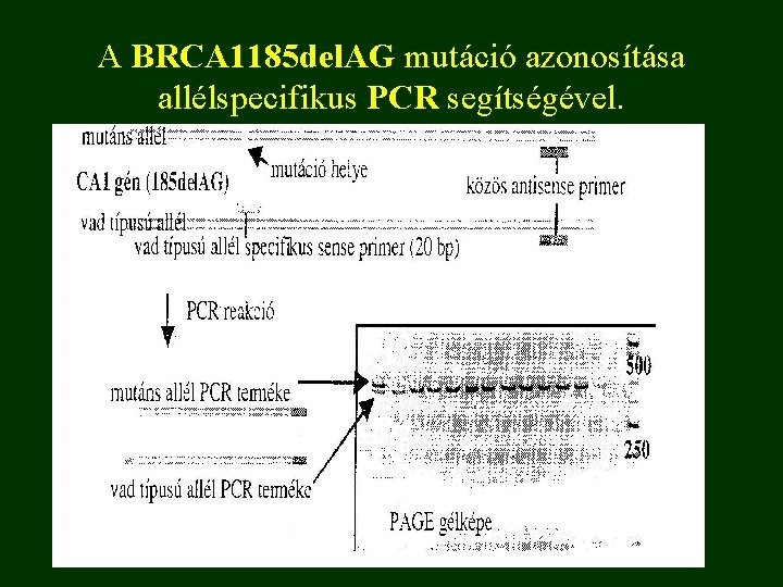 A BRCA 1185 del. AG mutáció azonosítása allélspecifikus PCR segítségével. 