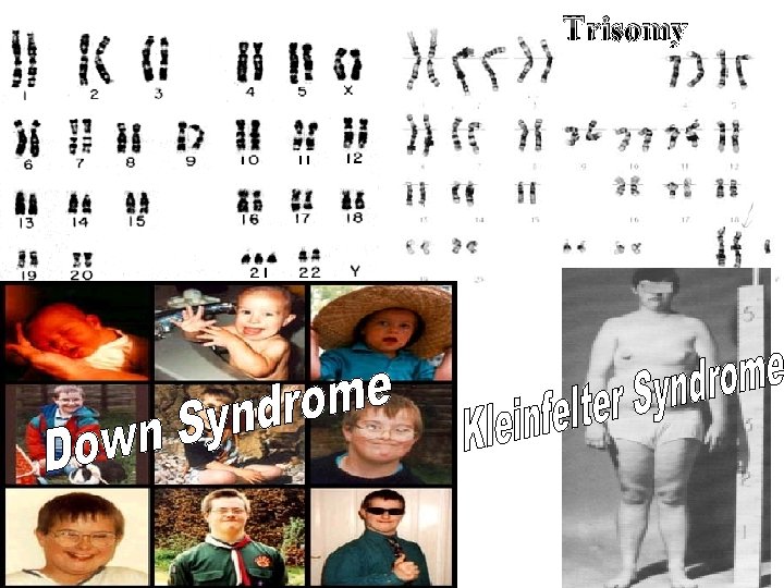 Trisomy 