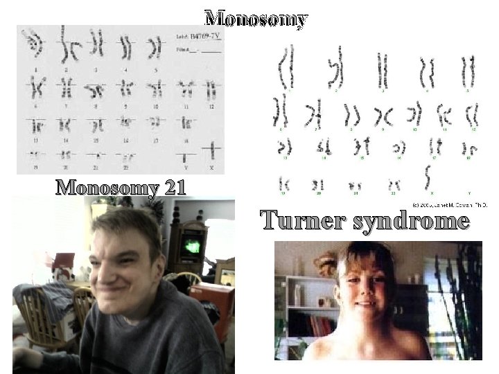 Monosomy 21 Turner syndrome 