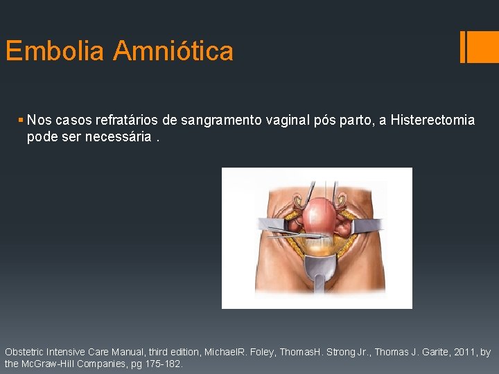 Embolia Amniótica § Nos casos refratários de sangramento vaginal pós parto, a Histerectomia pode