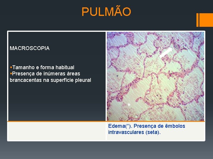 PULMÃO MACROSCOPIA §Tamanho e forma habitual §Presença de inúmeras áreas brancacentas na superfície pleural