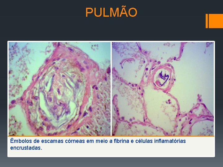 PULMÃO Êmbolos de escamas córneas em meio a fibrina e células inflamatórias encrustadas. 