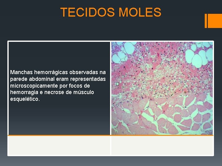 TECIDOS MOLES Manchas hemorrágicas observadas na parede abdominal eram representadas microscopicamente por focos de