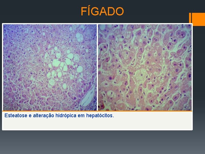 FÍGADO Esteatose e alteração hidrópica em hepatócitos. 