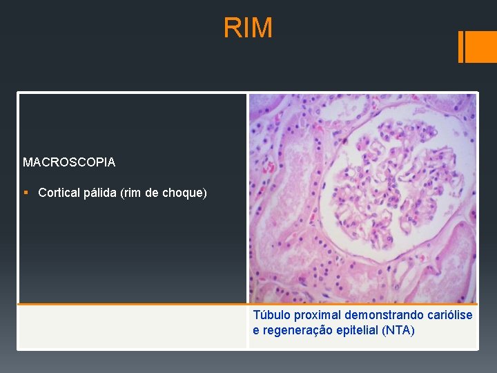 RIM MACROSCOPIA § Cortical pálida (rim de choque) Túbulo proximal demonstrando cariólise e regeneração