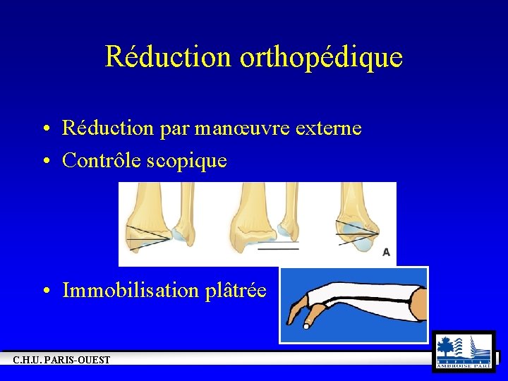 Réduction orthopédique • Réduction par manœuvre externe • Contrôle scopique • Immobilisation plâtrée C.