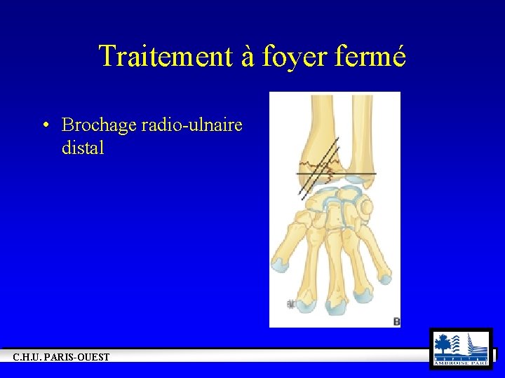 Traitement à foyer fermé • Brochage radio-ulnaire distal C. H. U. PARIS-OUEST 