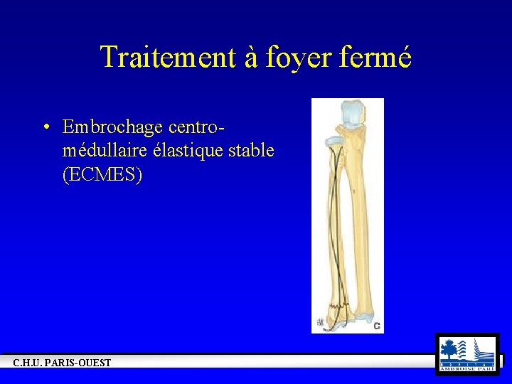 Traitement à foyer fermé • Embrochage centromédullaire élastique stable (ECMES) C. H. U. PARIS-OUEST