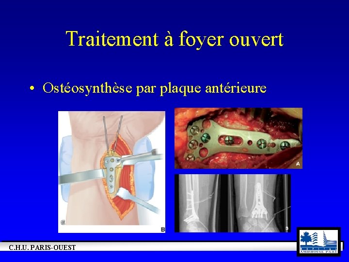 Traitement à foyer ouvert • Ostéosynthèse par plaque antérieure C. H. U. PARIS-OUEST 