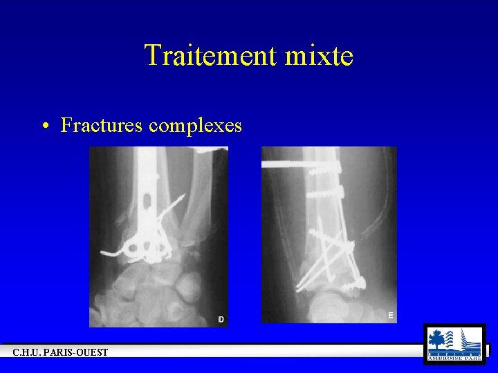 Traitement mixte • Fractures complexes C. H. U. PARIS-OUEST 