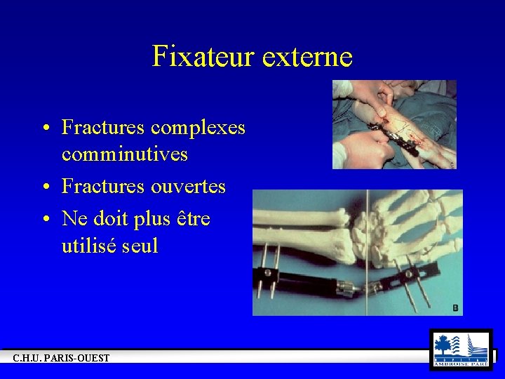 Fixateur externe • Fractures complexes comminutives • Fractures ouvertes • Ne doit plus être