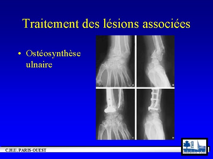 Traitement des lésions associées • Ostéosynthèse ulnaire C. H. U. PARIS-OUEST 