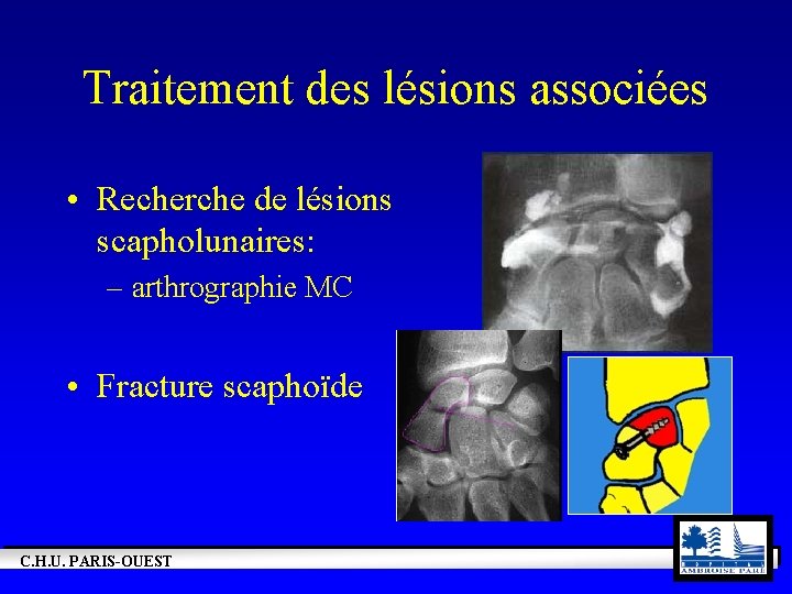 Traitement des lésions associées • Recherche de lésions scapholunaires: – arthrographie MC • Fracture