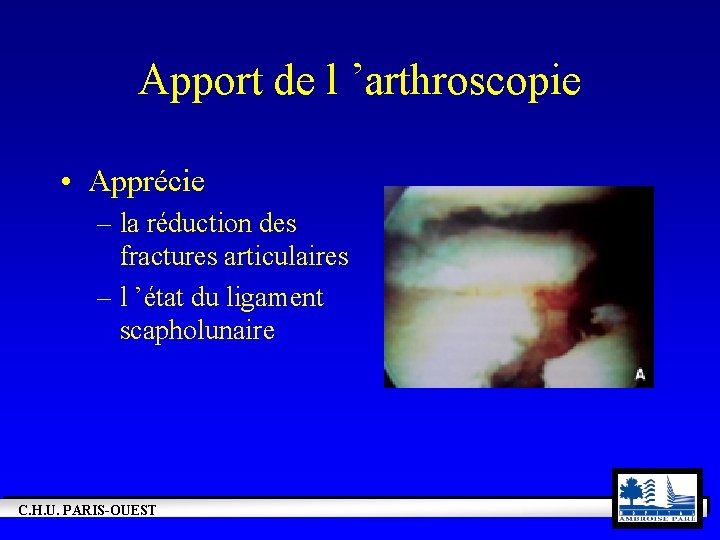 Apport de l ’arthroscopie • Apprécie – la réduction des fractures articulaires – l