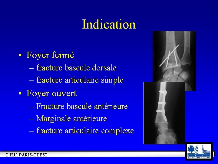 Indication • Foyer fermé – fracture bascule dorsale – fracture articulaire simple • Foyer