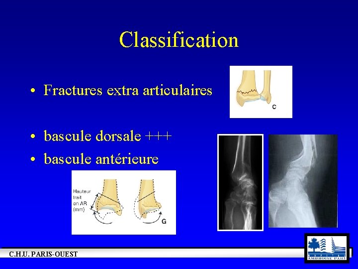 Classification • Fractures extra articulaires • bascule dorsale +++ • bascule antérieure C. H.