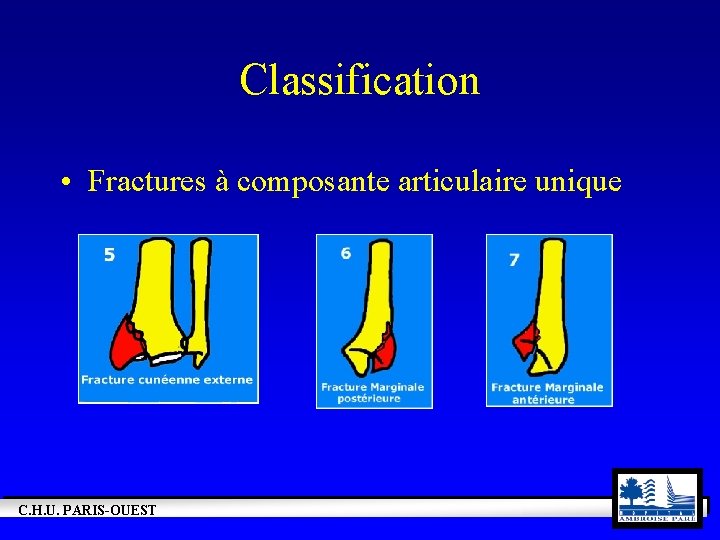 Classification • Fractures à composante articulaire unique C. H. U. PARIS-OUEST 