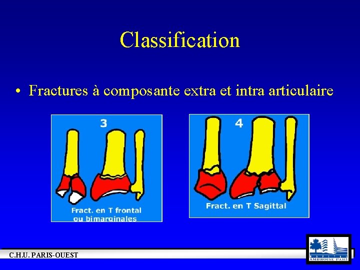 Classification • Fractures à composante extra et intra articulaire C. H. U. PARIS-OUEST 