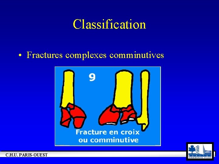 Classification • Fractures complexes comminutives C. H. U. PARIS-OUEST 