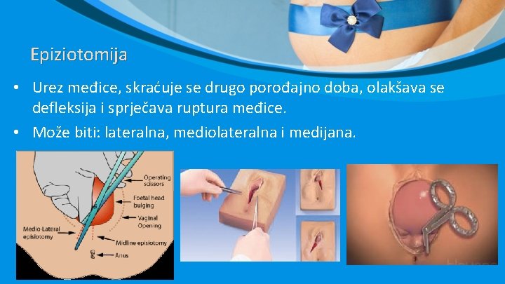 Epiziotomija • Urez međice, skraćuje se drugo porođajno doba, olakšava se defleksija i sprječava Epiziotomija • Urez međice, skraćuje se drugo porođajno doba, olakšava se defleksija i sprječava