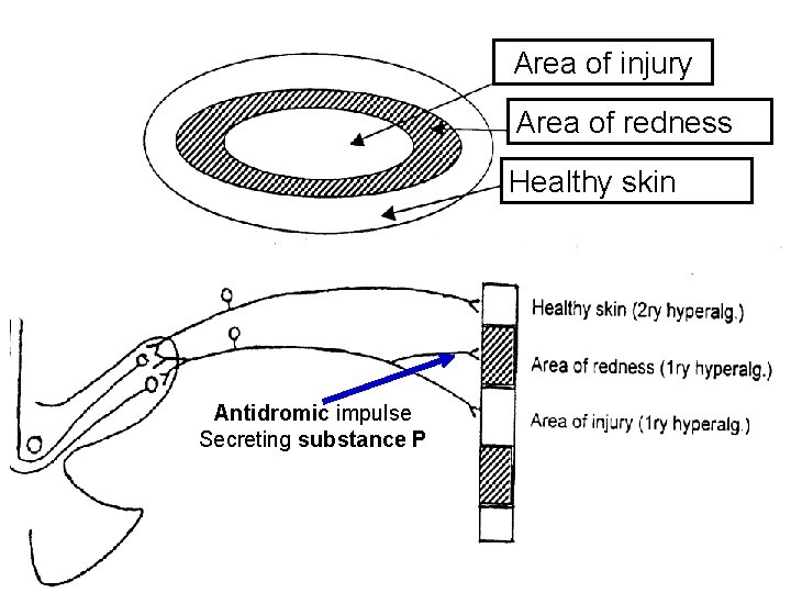 Area of injury Area of redness Healthy skin Antidromic impulse Secreting substance P 