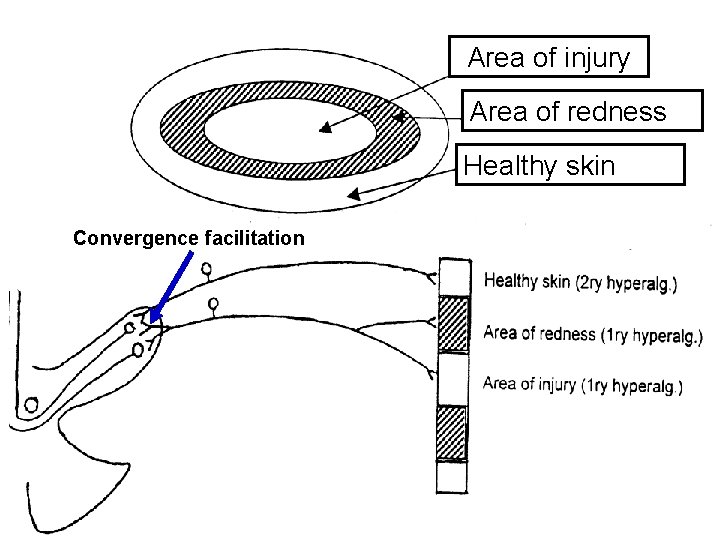 Area of injury Area of redness Healthy skin Convergence facilitation 