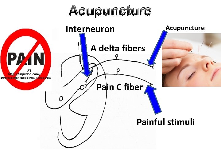 Acupuncture Interneuron Acupuncture A delta fibers Pain C fiber Painful stimuli 