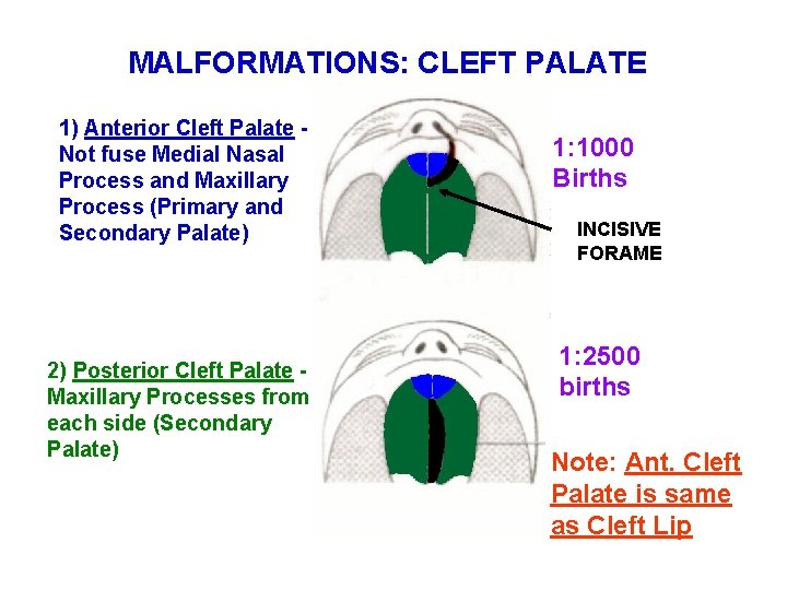 MALFORMATIONS: CLEFT PALATE 1) Anterior Cleft Palate Not fuse Medial Nasal Process and Maxillary