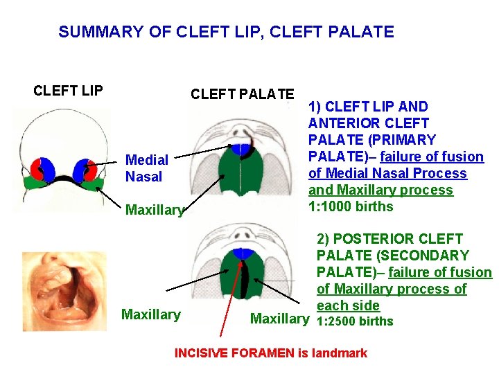 SUMMARY OF CLEFT LIP, CLEFT PALATE CLEFT LIP CLEFT PALATE Medial Nasal Maxillary 1)