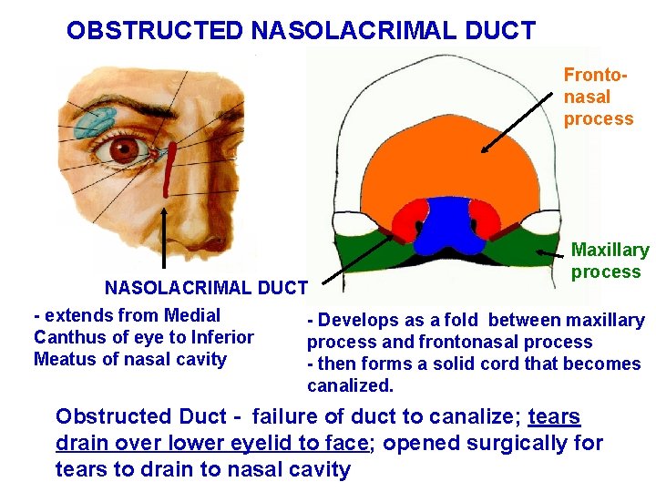 OBSTRUCTED NASOLACRIMAL DUCT Frontonasal process Maxillary process NASOLACRIMAL DUCT - extends from Medial - OBSTRUCTED NASOLACRIMAL DUCT Frontonasal process Maxillary process NASOLACRIMAL DUCT - extends from Medial -