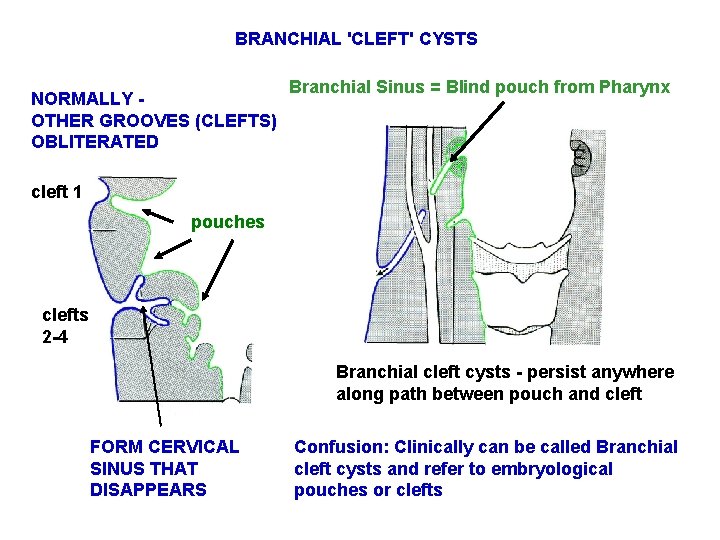 BRANCHIAL 'CLEFT' CYSTS NORMALLY OTHER GROOVES (CLEFTS) OBLITERATED Branchial Sinus = Blind pouch from BRANCHIAL 'CLEFT' CYSTS NORMALLY OTHER GROOVES (CLEFTS) OBLITERATED Branchial Sinus = Blind pouch from